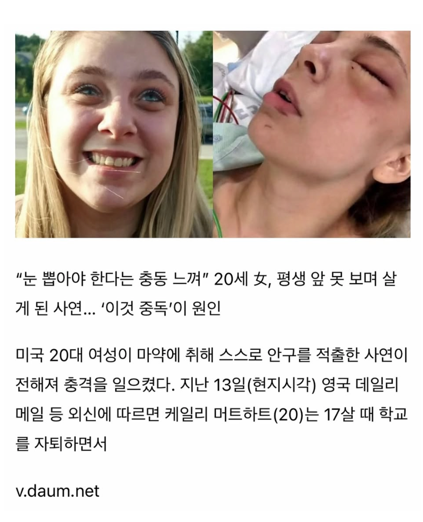 스스로 본인 눈알을 뽑아버린 20세 여성 