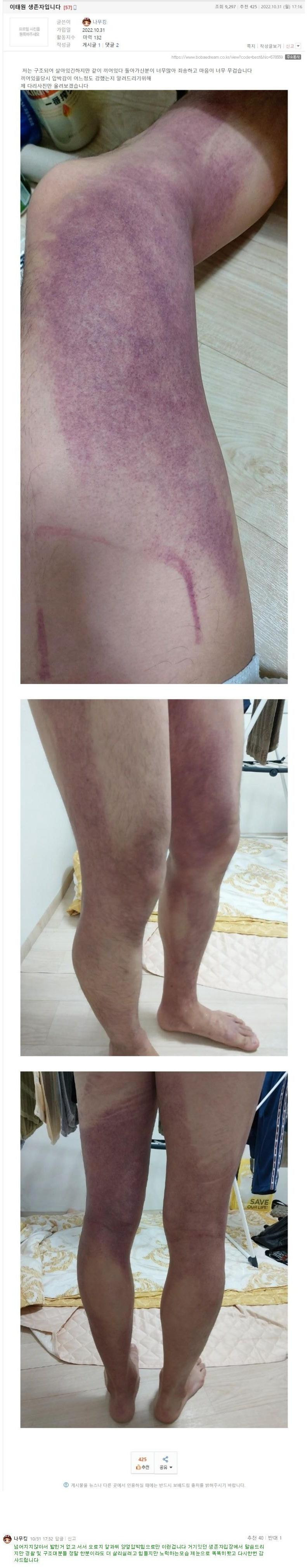 이태원 참사 생존자가 올린 자기 다리 상태 ㅎㄷㄷ